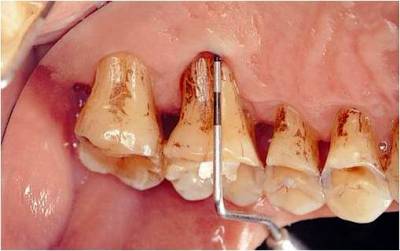 例行口腔檢查　竟發現齒槽骨嚴重被破壞