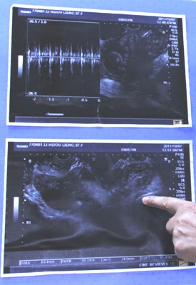 孕婦懷雙胞胎　一個在子宮內、另一個竟在輸卵管！