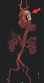 先進混合式主動脈支架血管手術　成功修復急性A型主動脈剝離