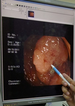 大陸籍老翁高級健檢意外發現直腸癌　腹腔鏡手術切除