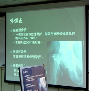 被蛀掉的骨頭！　淺談缺血性股骨頭壞死