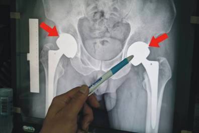 走路像機器人　原來是兩側股骨頭同時壞