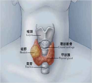 頸部疑似腫塊突起　當心為甲狀腺結節