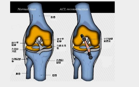 十字韌帶重建手術　膝關節不用切開、打洞用內視鏡即可
