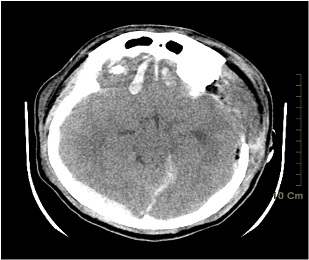 雙側開顱手術　救回嚴重外傷性腦出血醉漢