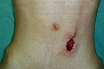 無傷口的單孔腹腔鏡大腸癌手術