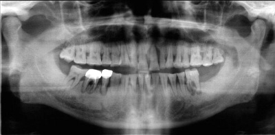 牙根斷裂也會引起蜂窩性組織炎