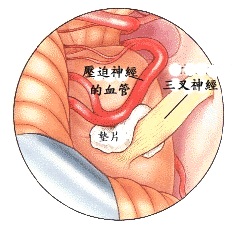 插在臉頰上的針　三叉神經痛