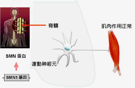 飛不遠的天使　脊髓性肌肉萎縮症