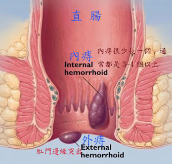 懷孕得子不得痔　教妳如何保健