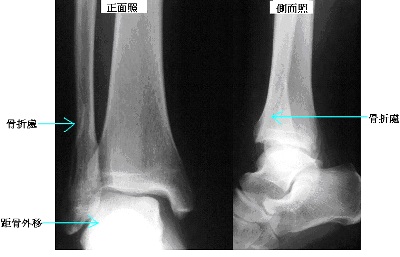 外踝骨折手術新選擇　微創骨髓內釘治療