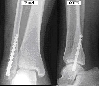 外踝骨折手術新選擇　微創骨髓內釘治療