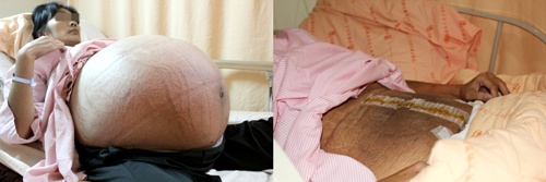 鄒族婦人大腹便便如5胞胎　2年長出21公斤卵巢癌