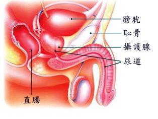 攝護腺雷射手術治療出血少、疼痛少　降低手術的風險