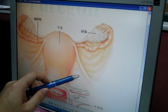 產婦腸卡子宮寬韌帶破洞　喜迎新生險送命