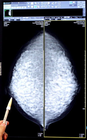 早期乳癌該如何治療？