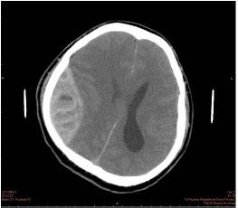 男車禍腦出血頭骨骨折　外科輔以高壓氧治療恢復行動