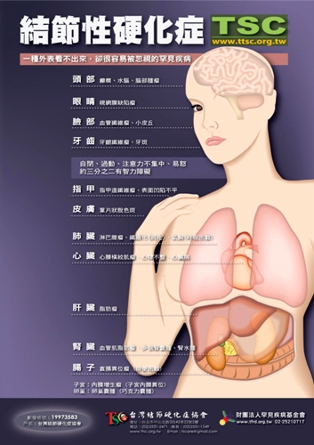 雖年齡增長惡化　結節性硬化症會侵犯心臟、腦部