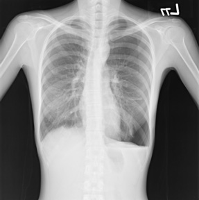 自發性氣胸胸痛、呼吸急　胸腔外科常見疾病