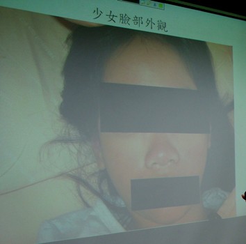 腹痛、反覆發燒！少女竟罹紅斑性狼瘡