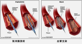 胸悶、心臟砰砰跳　我會猝死嗎？