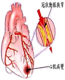 胸悶、心臟砰砰跳　我會猝死嗎？