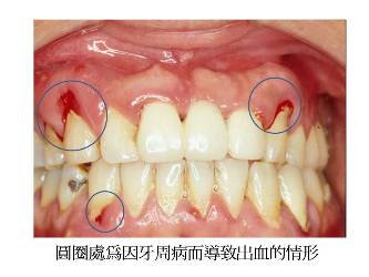 懷一個孩子　就壞一顆牙？！