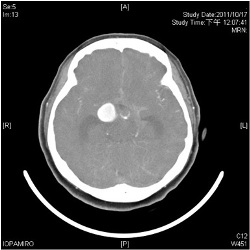 腦動脈瘤作祟　女頭痛、四肢無力