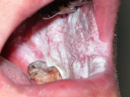口腔不正常白斑與紅斑　當心口腔癌