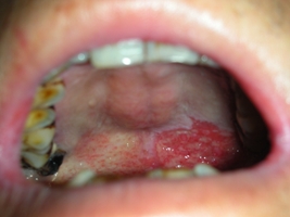 口腔不正常白斑與紅斑　當心口腔癌