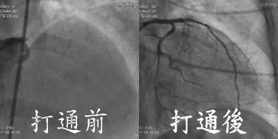 全身冒汗、胸口痛　急性心肌梗塞作祟