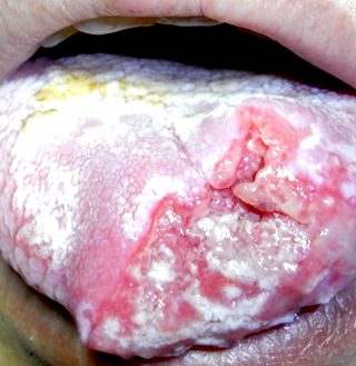 齿列不整竟会致命!女子常咬到舌头 年纪轻轻罹舌癌 , 疾病预防 , PChome Online 健康乐活