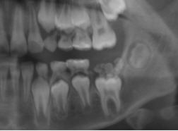 十二岁儿童下颚第一恒臼齿未长出,竟是牙瘤所致