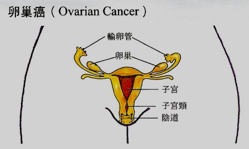 频尿,经期不顺 竟是罹患卵巢癌
