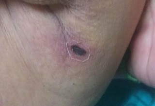 还清白!他「小弟弟」溃疡 恙虫病误认染梅毒