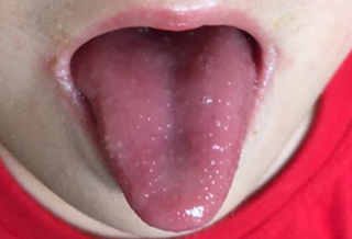 舌頭長草莓？A型鏈球菌害的