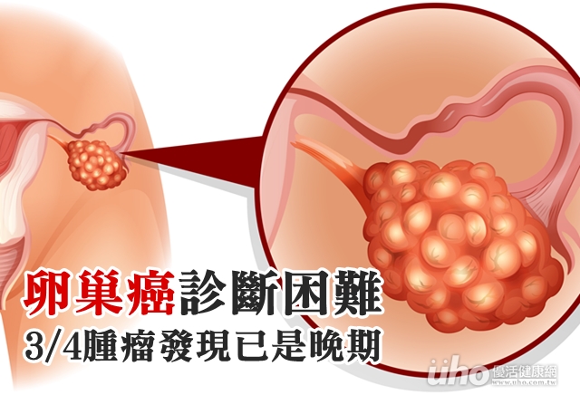 卵巢癌診斷困難　3/4腫瘤發現已是晚期