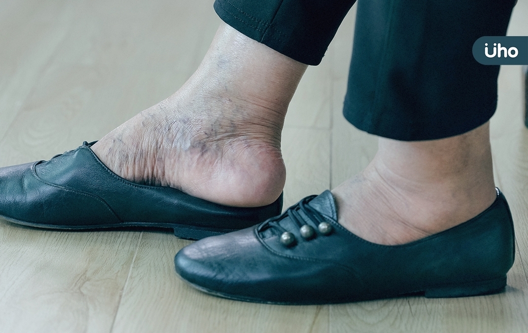鞋子越買越大、戒指戴不下、下巴變長⋯恐「肢端肥大症」醫揭7大特徵
