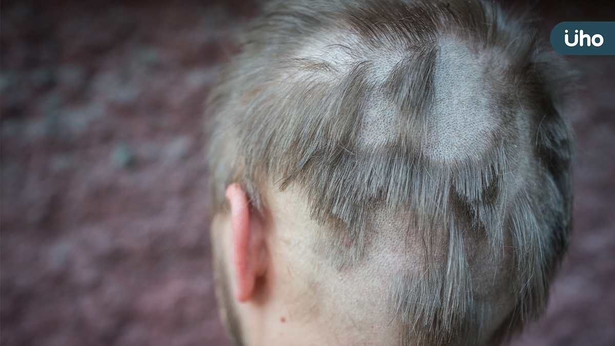 全台統計超過五千人受圓形禿所苦  臺灣研究皮膚科醫學會將舉辦毛髮論壇