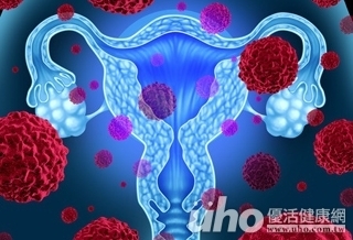 性經驗早、多育　小心成為子宮頸癌候選人！