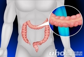 腸胃操勞4不足　恐患大腸癌