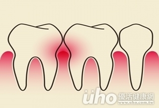 口腔保健弱　牙周病擾90％人