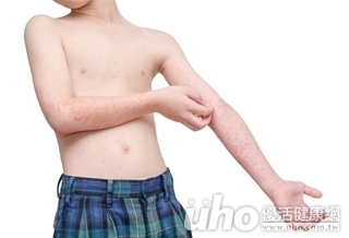 醫：乳酸桿菌LGG　降低寶寶異位性皮膚炎發生