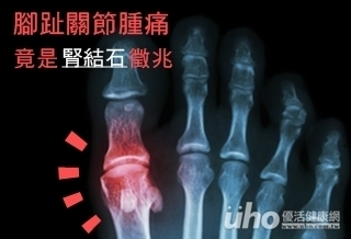 腳趾關節腫痛　竟是腎結石徵兆