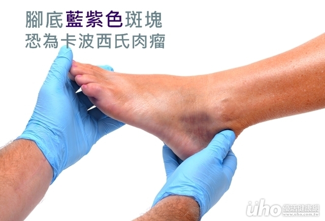 腳底藍紫色斑塊　典型卡波西氏肉瘤