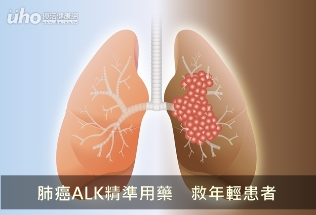 肺癌ALK精準用藥　救年輕患者