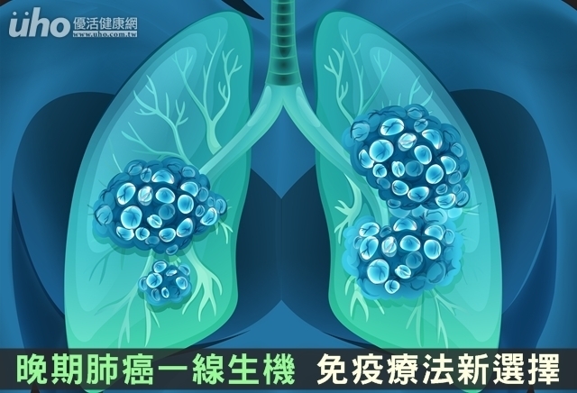 晚期肺癌一線生機　免疫療法新選擇