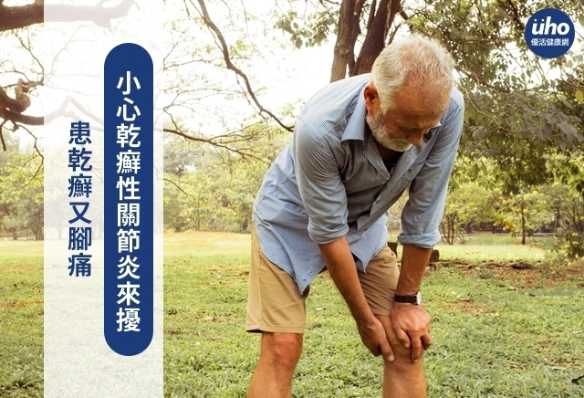 患乾癬又腳痛　小心乾癬性關節炎來擾