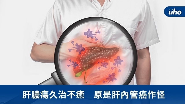 肝膿瘍久治不癒　原是肝內管癌作怪