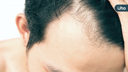 落髮竟會擴散傳染！皮膚科醫師：台灣人「這族群」清潔習慣為主因